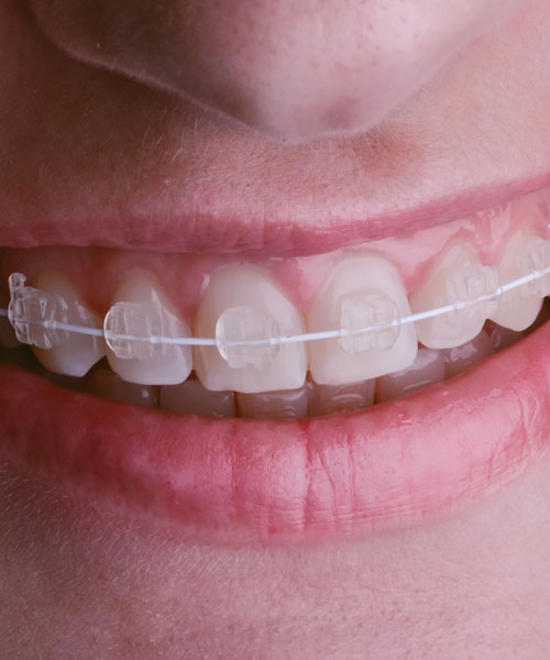 molestias-ortodoncia-autoligado