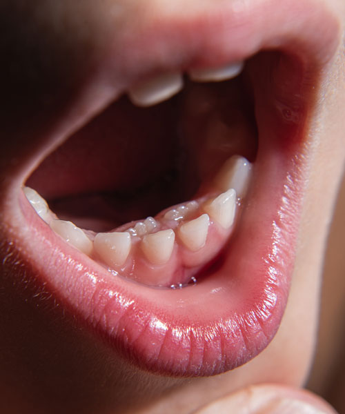 Boca de un niño con erupción de molares