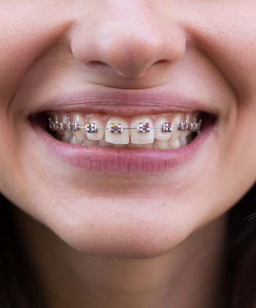 Chica joven sonriendo con ortodoncia de brackets metálicos