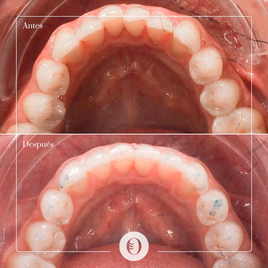 Caso clínico - Apiñamiento inferior ortodoncia