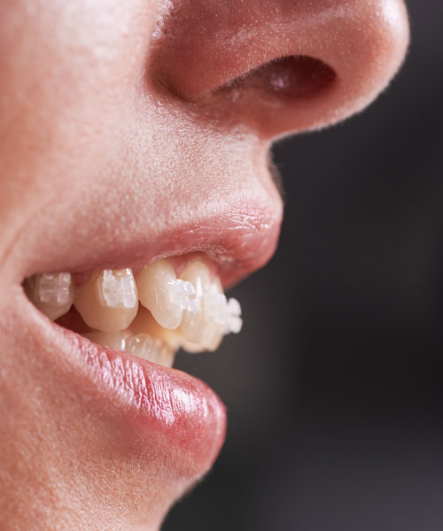Primer plano de mujer joven con la boca abierta mostrando dientes blancos con brackets de ortodoncia. Paciente femenina durante un tratamiento de ortodoncia. Concepto de tratamiento de ortodoncia y estomatología.