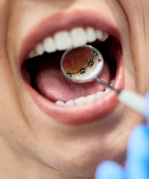 Primer plano de una mujer que se somete a una revisión de los aparatos dentales en la parte posterior de sus dientes en la consulta del dentista.