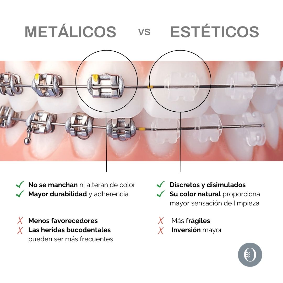 Diferencia entre brackets estéticos y metálicos Loscos Ortodoncia