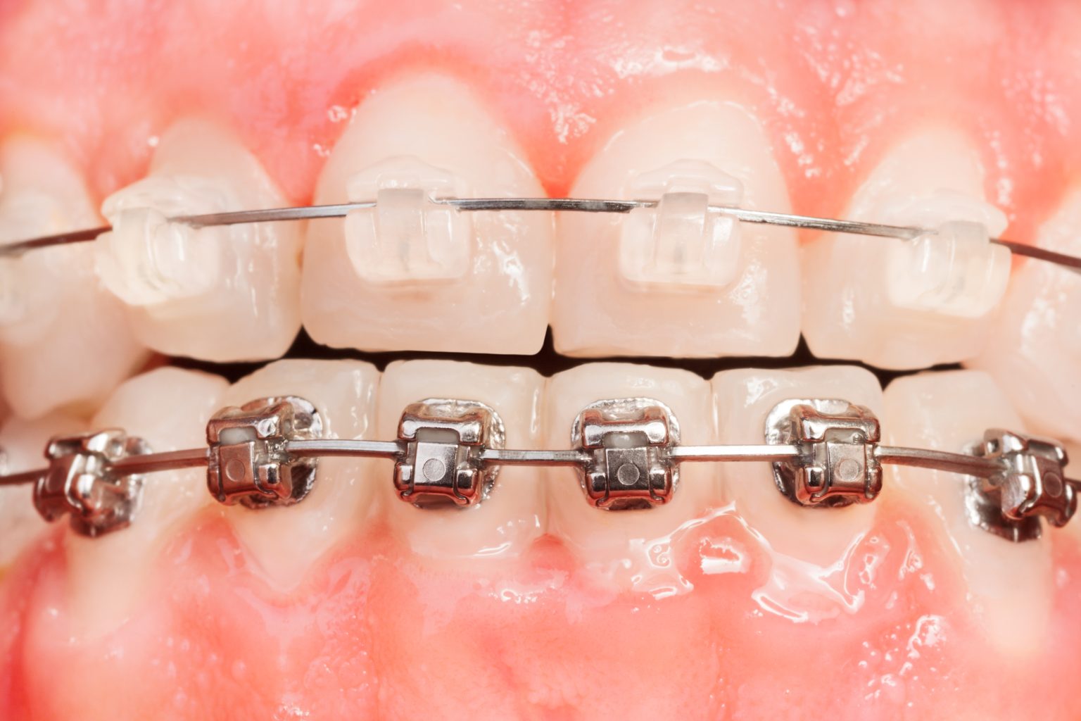 Diferencia entre brackets estéticos y metálicos - Loscos Ortodoncia