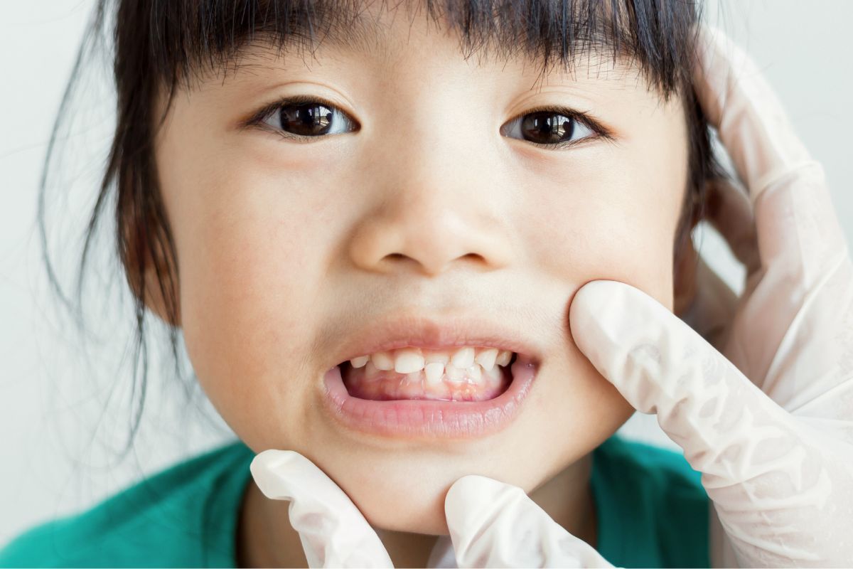 maloclusión dental infantil