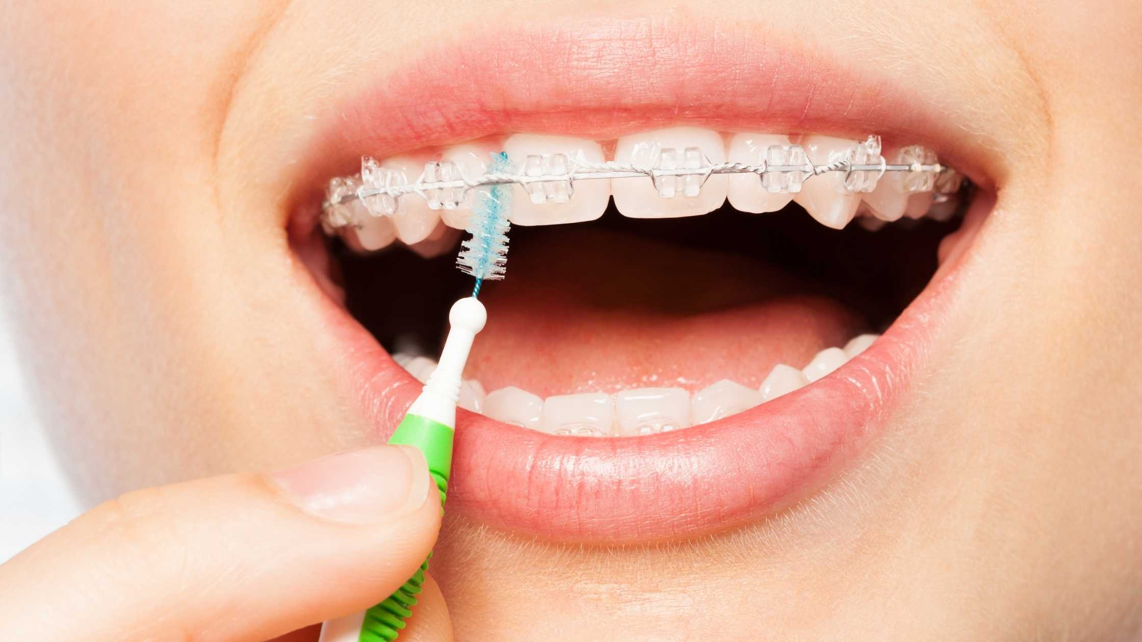 Cómo cepillarse los dientes con brackets
