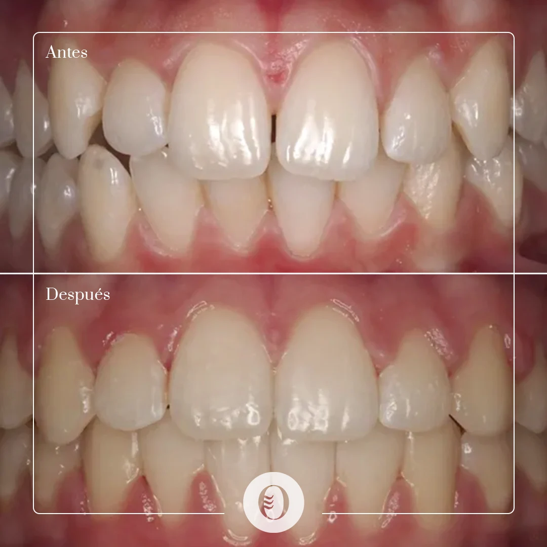 caso-brackets-06-front