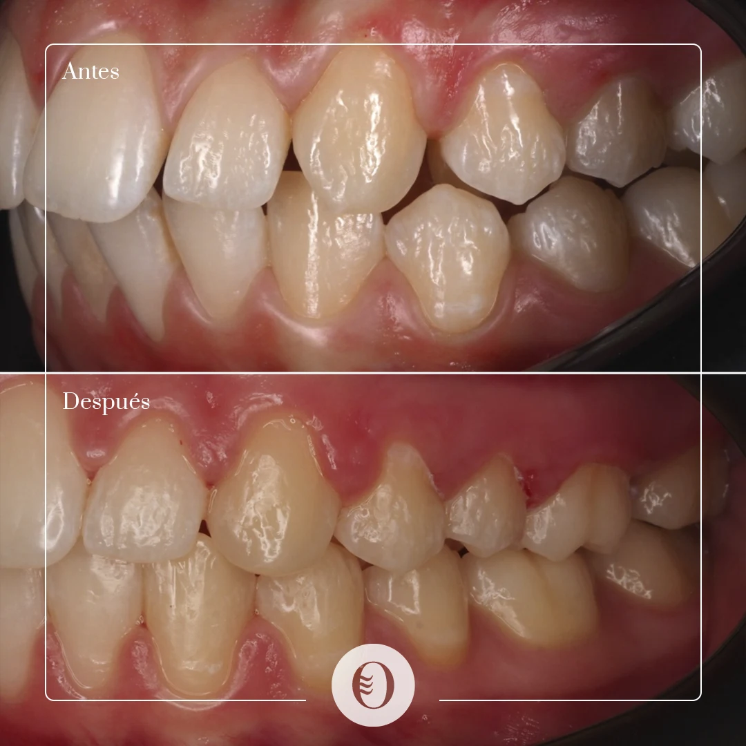 caso-brackets-06-left