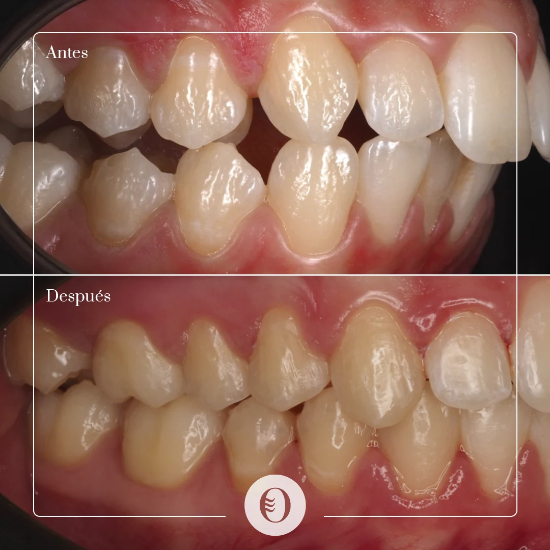 caso-brackets-06-right