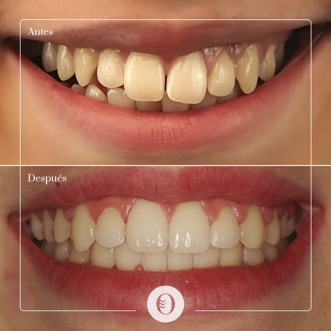 caso-brackets-06-smile