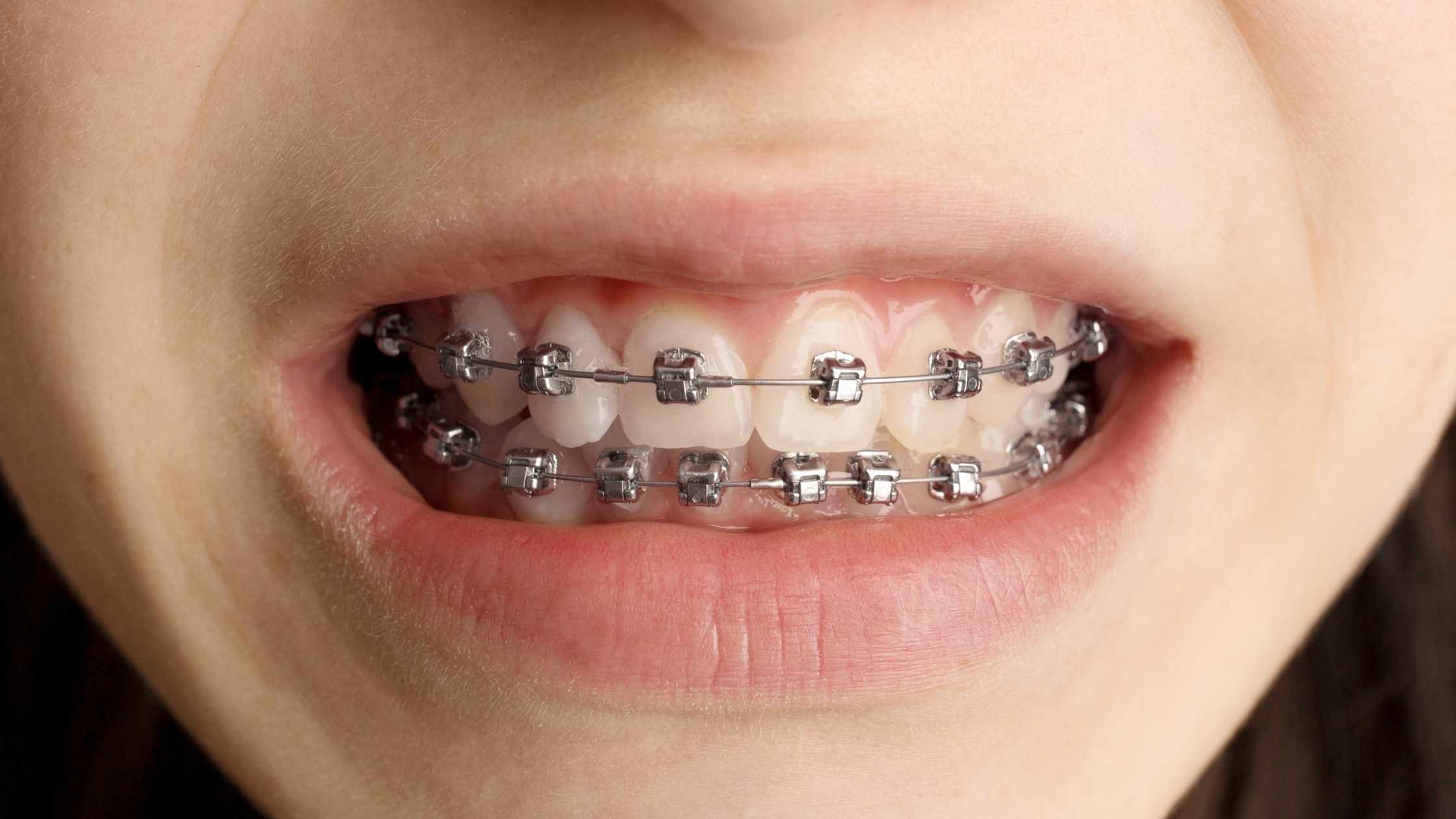 estres dientes ortodoncia