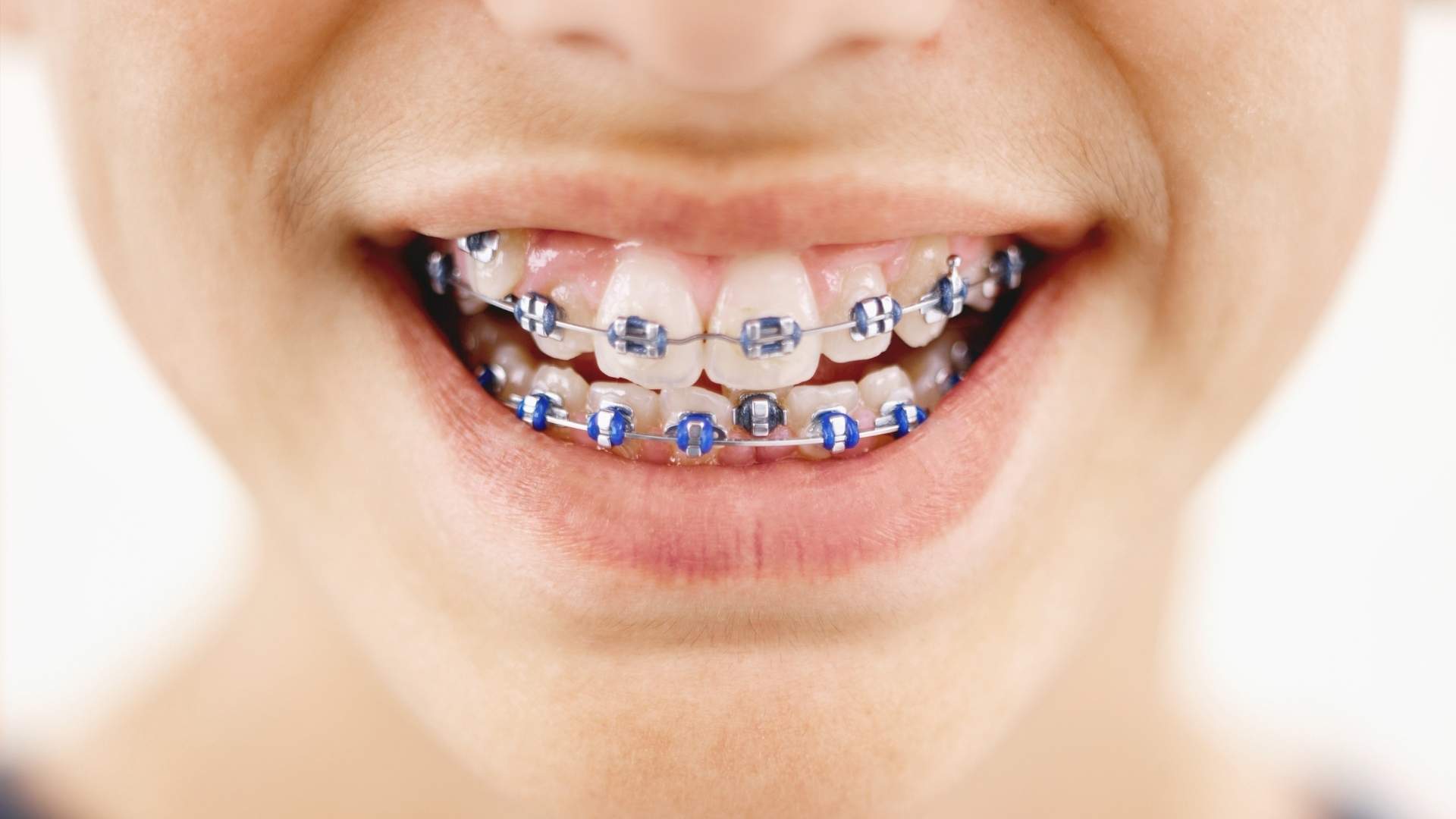 movimiento-dientes-durante-ortodoncia