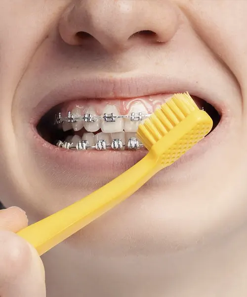 Demostración de cómo limpiar ortodoncia con cepillo