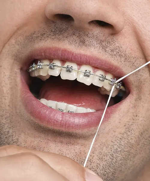 Demostración de cómo limpiar ortodoncia con hilo interdental