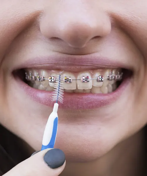 Demostración de cómo limpiar ortodoncia con cepillo interdental